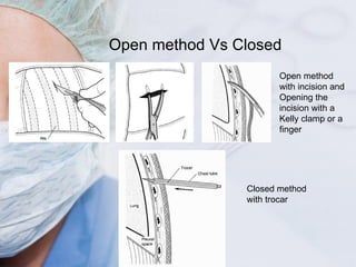 Open method Vs Closed Closed method with trocar Open method with incision and Opening the incision with a Kelly clamp or a...