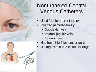 Nontunneled Central Venous Catheters <ul><li>Used for short-term therapy </li></ul><ul><li>Inserted percutaneously  </li><...