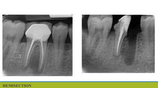 Tooth Hemisection Surgical endodntics | PPT