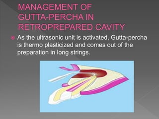  As the ultrasonic unit is activated, Gutta-percha
is thermo plasticized and comes out of the
preparation in long strings.
 