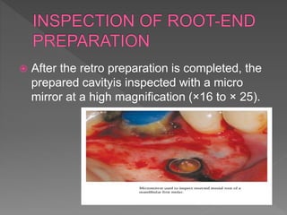  After the retro preparation is completed, the
prepared cavityis inspected with a micro
mirror at a high magnification (×16 to × 25).
 
