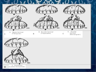 A
A . Sin g le V e r t i c a l
(T ria n g u l a r ) B
B . D o u b le V e r t i c a l
(T r a p e z oid a l) c
C . D o u b le
V e r t ic a l
( R e c t a n g u la r)
0 . S c a l lo p e d
(L u e b k e - O c h s e n b ein )
 