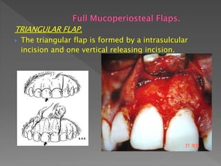 TRIANGULAR FLAP.
 The triangular flap is formed by a intrasulcular
incision and one vertical releasing incision.
 