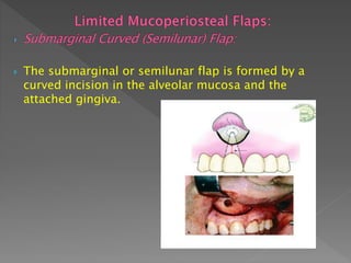  The submarginal or semilunar flap is formed by a
curved incision in the alveolar mucosa and the
attached gingiva.
 