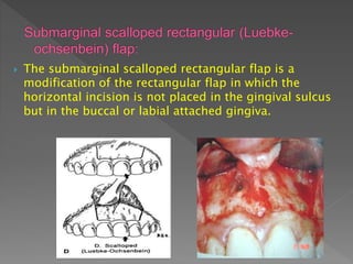  The submarginal scalloped rectangular flap is a
modification of the rectangular flap in which the
horizontal incision is not placed in the gingival sulcus
but in the buccal or labial attached gingiva.
 