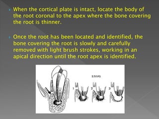  When the cortical plate is intact, locate the body of
the root coronal to the apex where the bone covering
the root is thinner.
 Once the root has been located and identified, the
bone covering the root is slowly and carefully
removed with light brush strokes, working in an
apical direction until the root apex is identified.
 