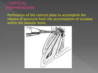  Perforation of the cortical plate to accomplish the
release of pressure from the accumulation of exudate
within the alveolar bone.
 