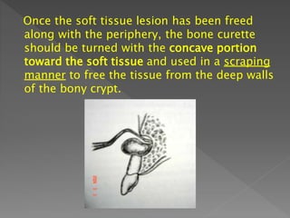 Once the soft tissue lesion has been freed
along with the periphery, the bone curette
should be turned with the concave portion
toward the soft tissue and used in a scraping
manner to free the tissue from the deep walls
of the bony crypt.
 