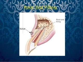 Root-end
filling
 