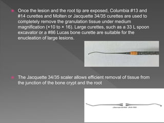  Once the lesion and the root tip are exposed, Columbia #13 and
#14 curettes and Molten or Jacquette 34/35 curettes are used to
completely remove the granulation tissue under medium
magnification (×10 to × 16). Large curettes, such as a 33 L spoon
excavator or a #86 Lucas bone curette are suitable for the
enucleation of large lesions.
 The Jacquette 34/35 scaler allows efficient removal of tissue from
the junction of the bone crypt and the root
 