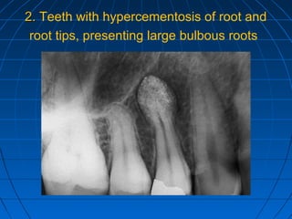 Surgical Exodontia PPT surgical-exodontia-ppt