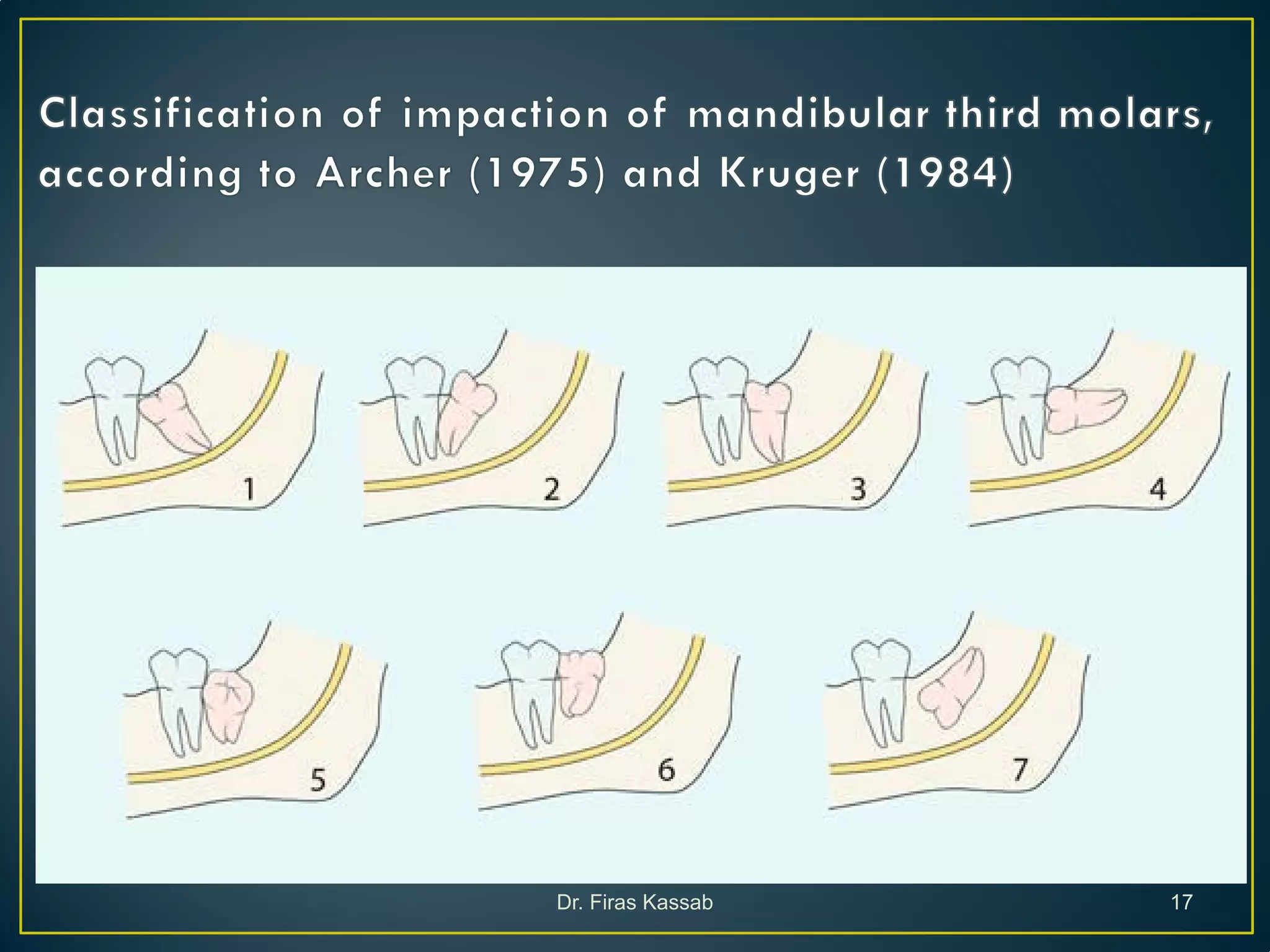 Surgical extraction of impacted teeth i | PDF