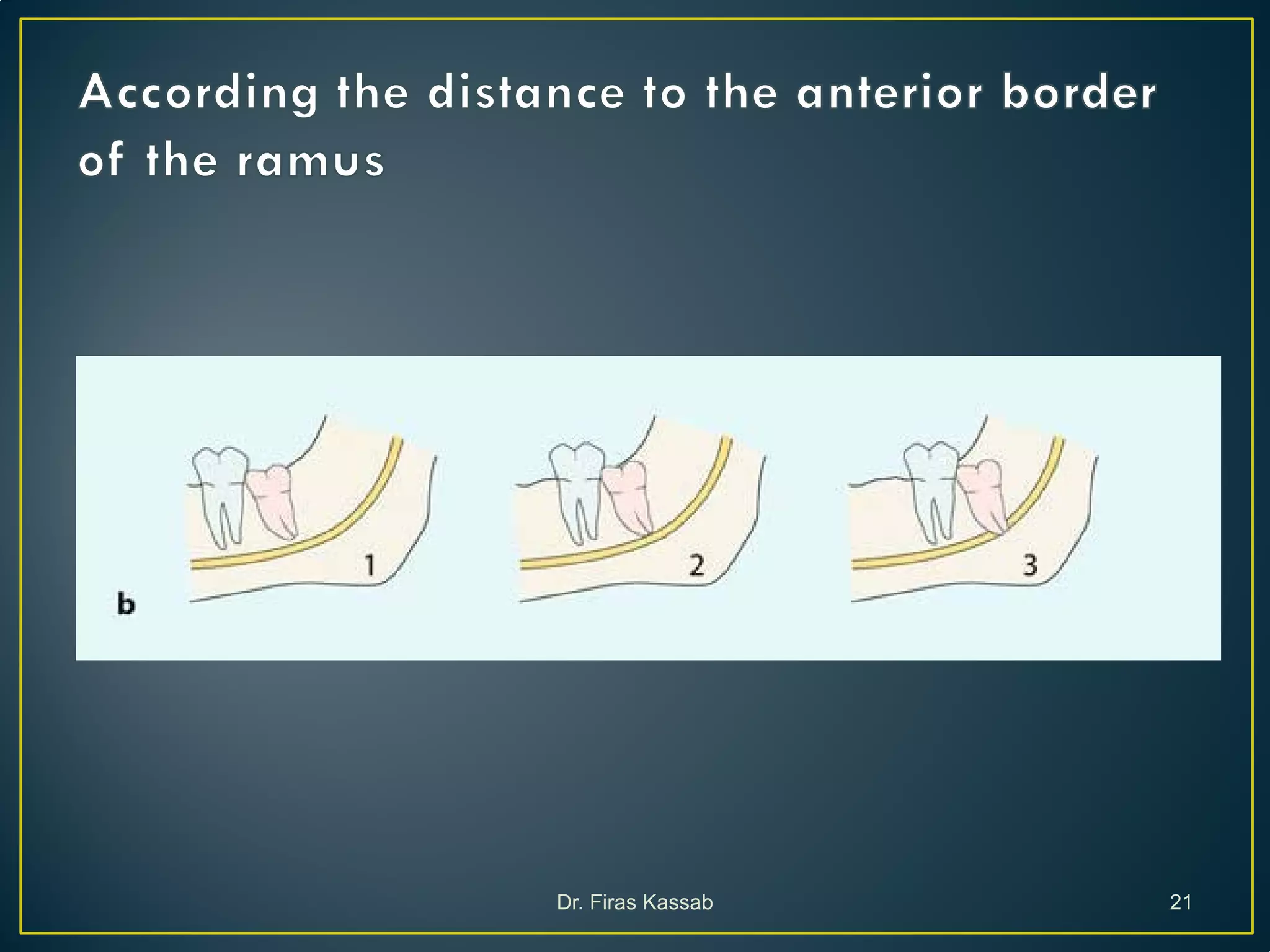 Surgical extraction of impacted teeth i | PDF