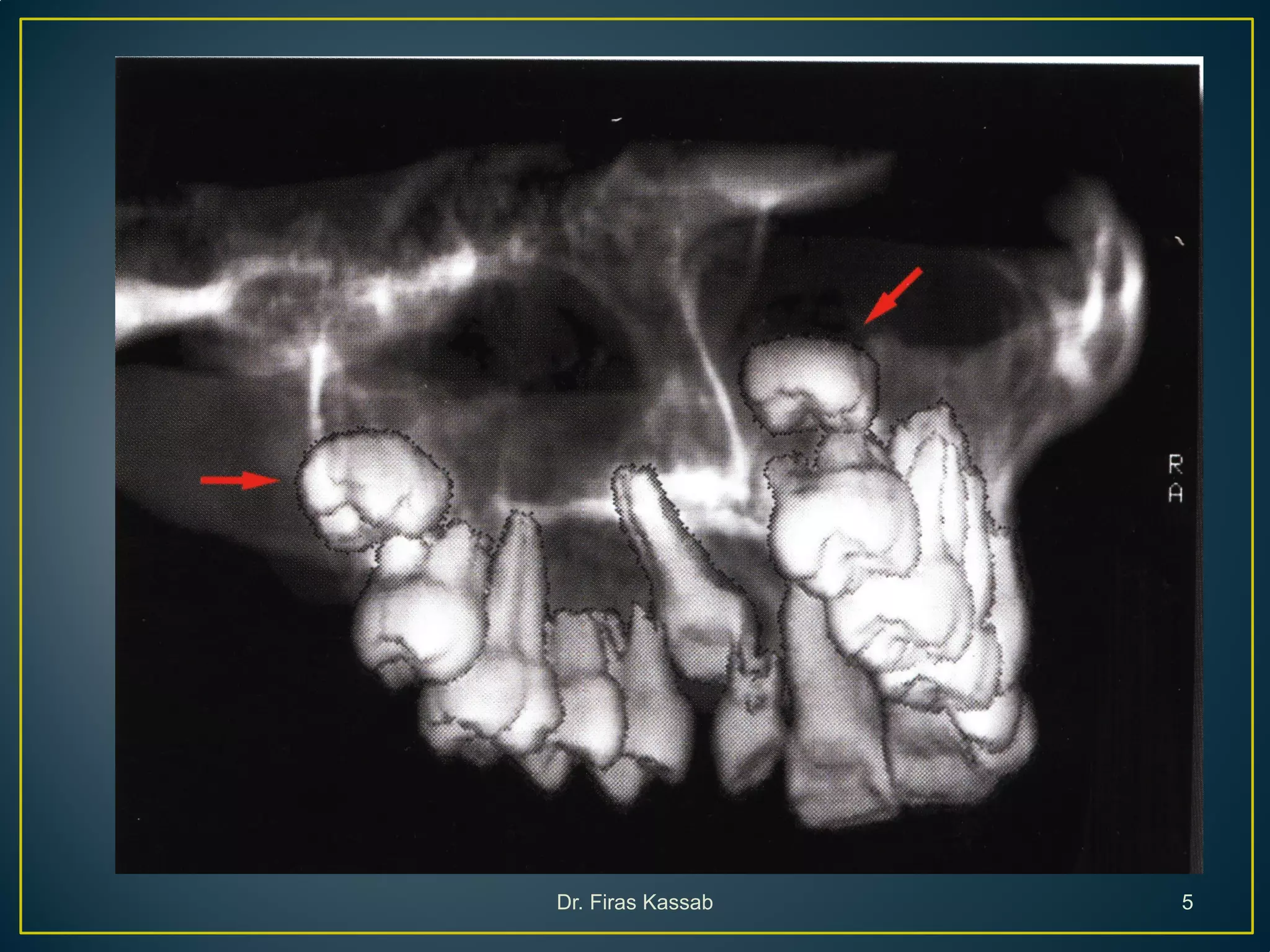 Surgical extraction of impacted teeth i | PDF