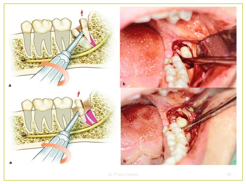 Surgical extraction of impacted teeth i