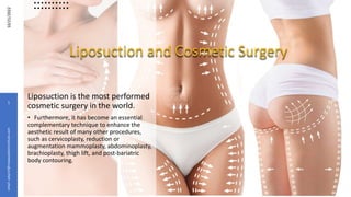 Liposuction and Cosmetic Surgery
10/21/2022
1
email:
askprof@moawadskininstitute.com
Liposuction is the most performed
cosmetic surgery in the world.
• Furthermore, it has become an essential
complementary technique to enhance the
aesthetic result of many other procedures,
such as cervicoplasty, reduction or
augmentation mammoplasty, abdominoplasty,
brachioplasty, thigh lift, and post-bariatric
body contouring.
 