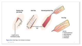 Surgical flaps in plastic surgery | PPTX