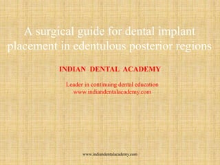 A surgical guide for dental implant
placement in edentulous posterior regions
INDIAN DENTAL ACADEMY
Leader in continuing dental education
www.indiandentalacademy.com
www.indiandentalacademy.com
 