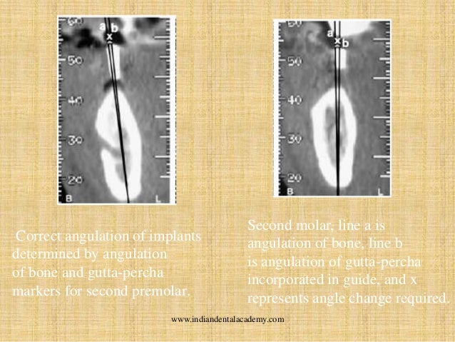 surgical guide for dental implant placement pdf