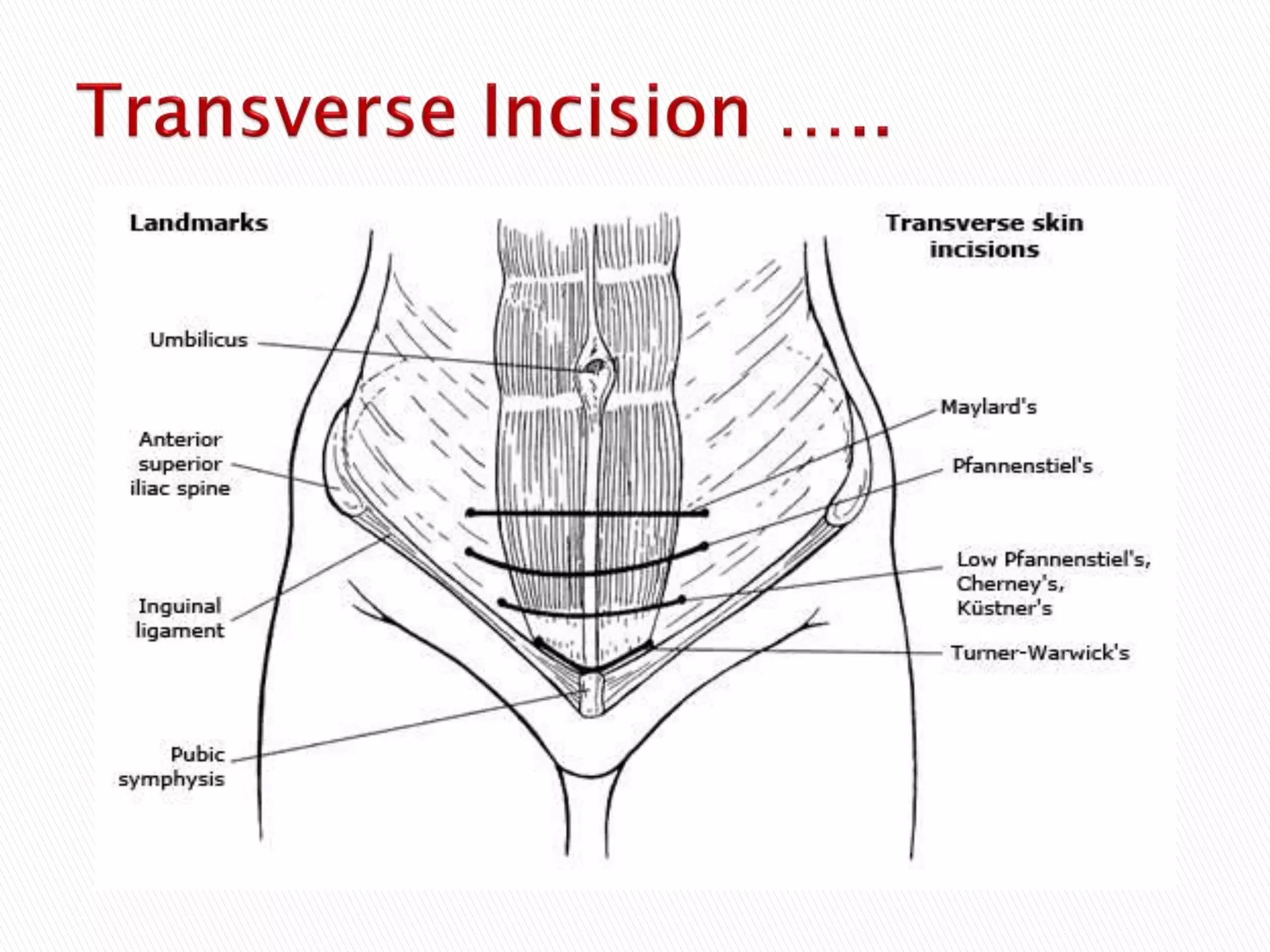 T Incision Classical Surgicalincisions 150519180458-lva1-app6892 | PPT