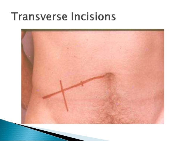 surgical incisions surgical incisions