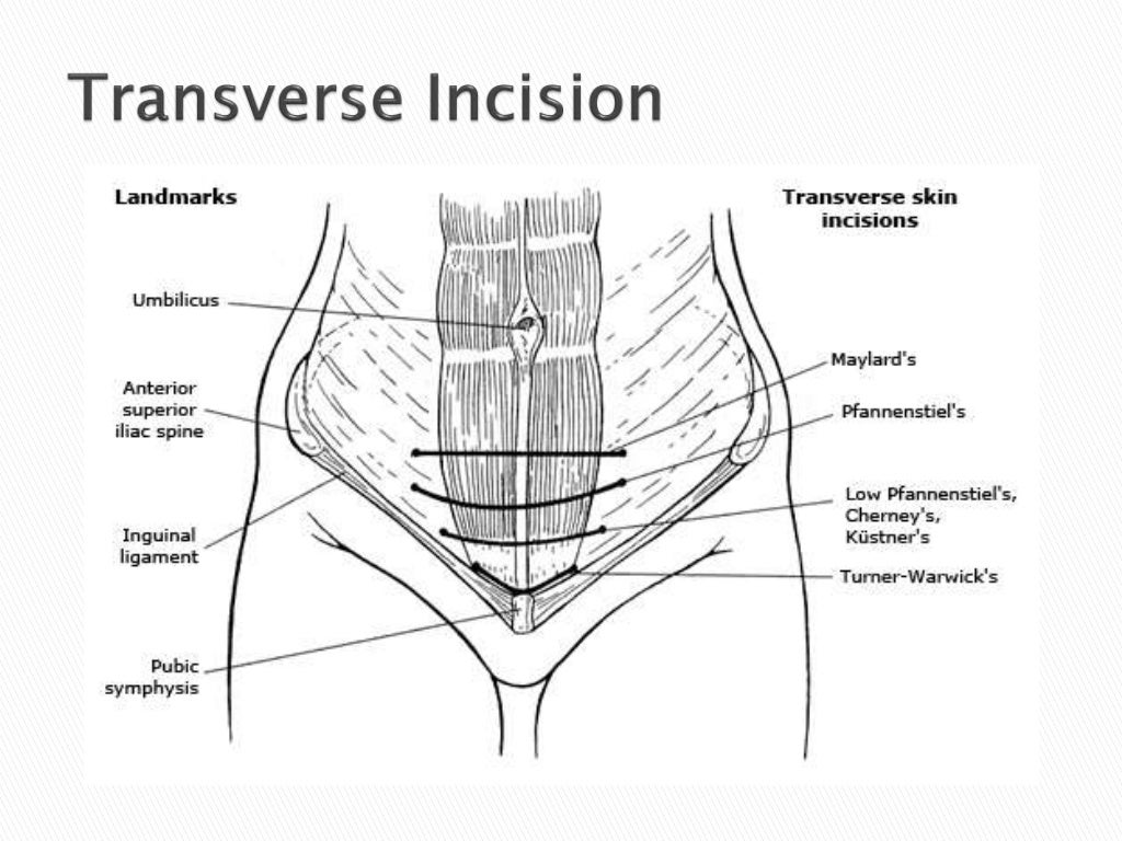 Surgical incisions