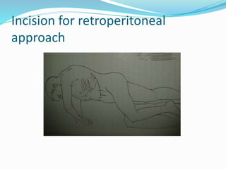 Incision for retroperitoneal
approach
 