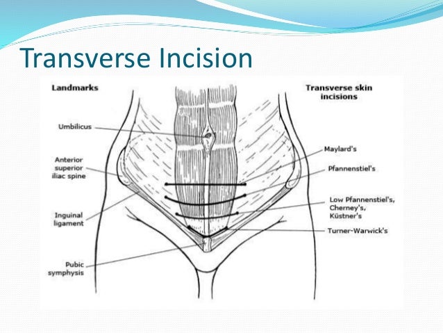 Appendectomy Incision Types