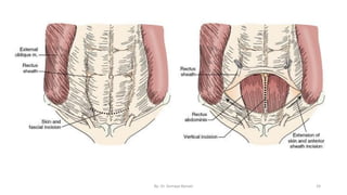 Surgical incisions