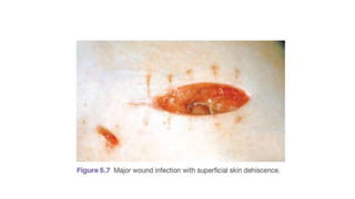 Surgical infection | PPTX