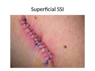 SURGICAL INFECTIONs.pptx and preventions | PPTX