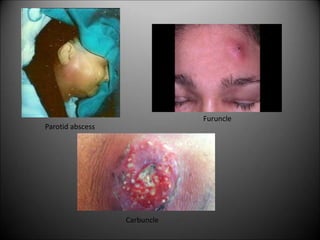 Parotid abscess
Furuncle
Carbuncle
 