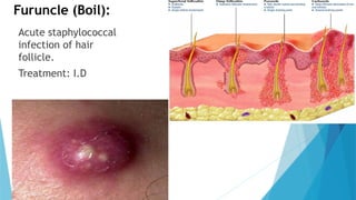 Surgical Infections ppt. with tables and detail | PPT