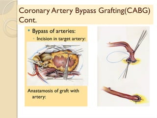 Comprehensive Surgical Interventions for Coronary Artery Disease ...
