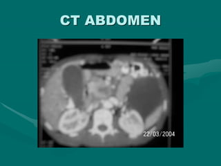 CT ABDOMEN
 