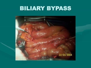 BILIARY BYPASS
 