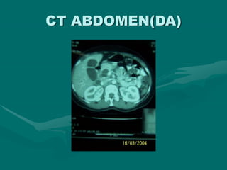 CT ABDOMEN(DA)
 