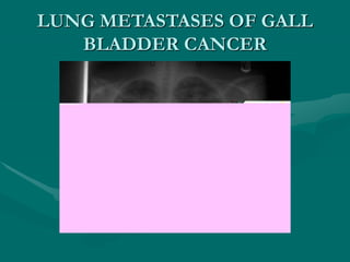 LUNG METASTASES OF GALL
BLADDER CANCER
 