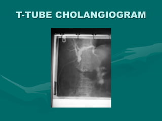 T-TUBE CHOLANGIOGRAM
 