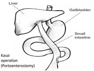 Kasai
operation
(Portoenterostomy)
 