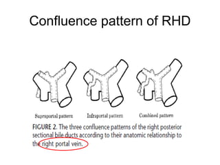 Confluence pattern of RHD
 