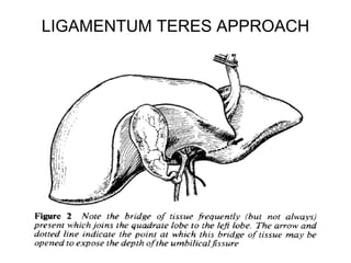 LIGAMENTUM TERES APPROACH
 