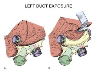 LEFT DUCT EXPOSURE
 