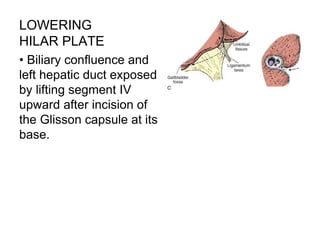 LOWERING
HILAR PLATE
• Biliary confluence and
left hepatic duct exposed
by lifting segment IV
upward after incision of
the Glisson capsule at its
base.
 