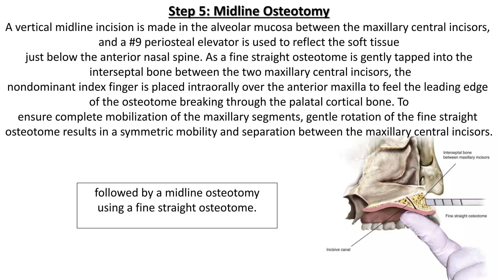 Surgically Assisted Rapid Palatal Expansion (SARPE) | PPTX