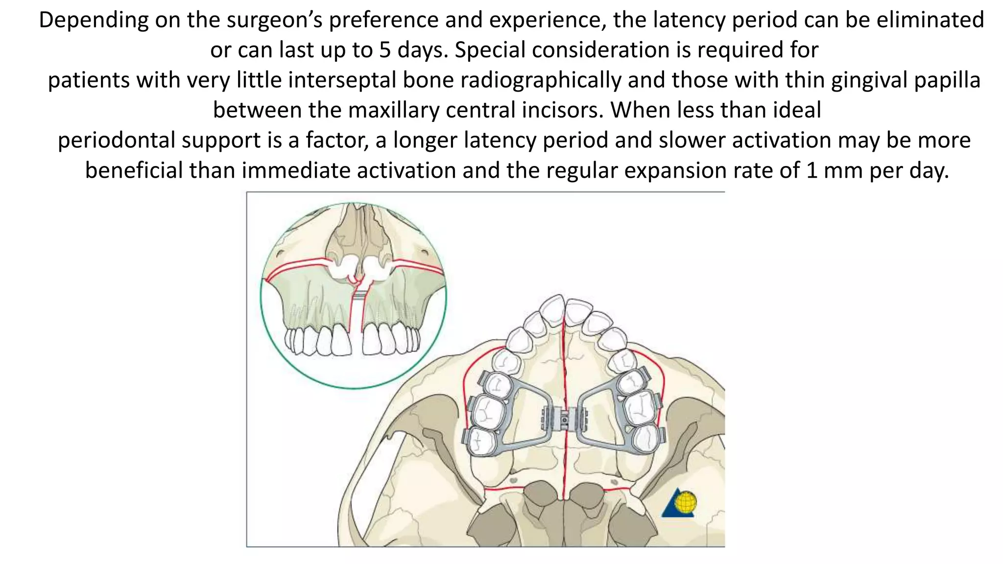 Surgically Assisted Rapid Palatal Expansion (SARPE) | PPTX