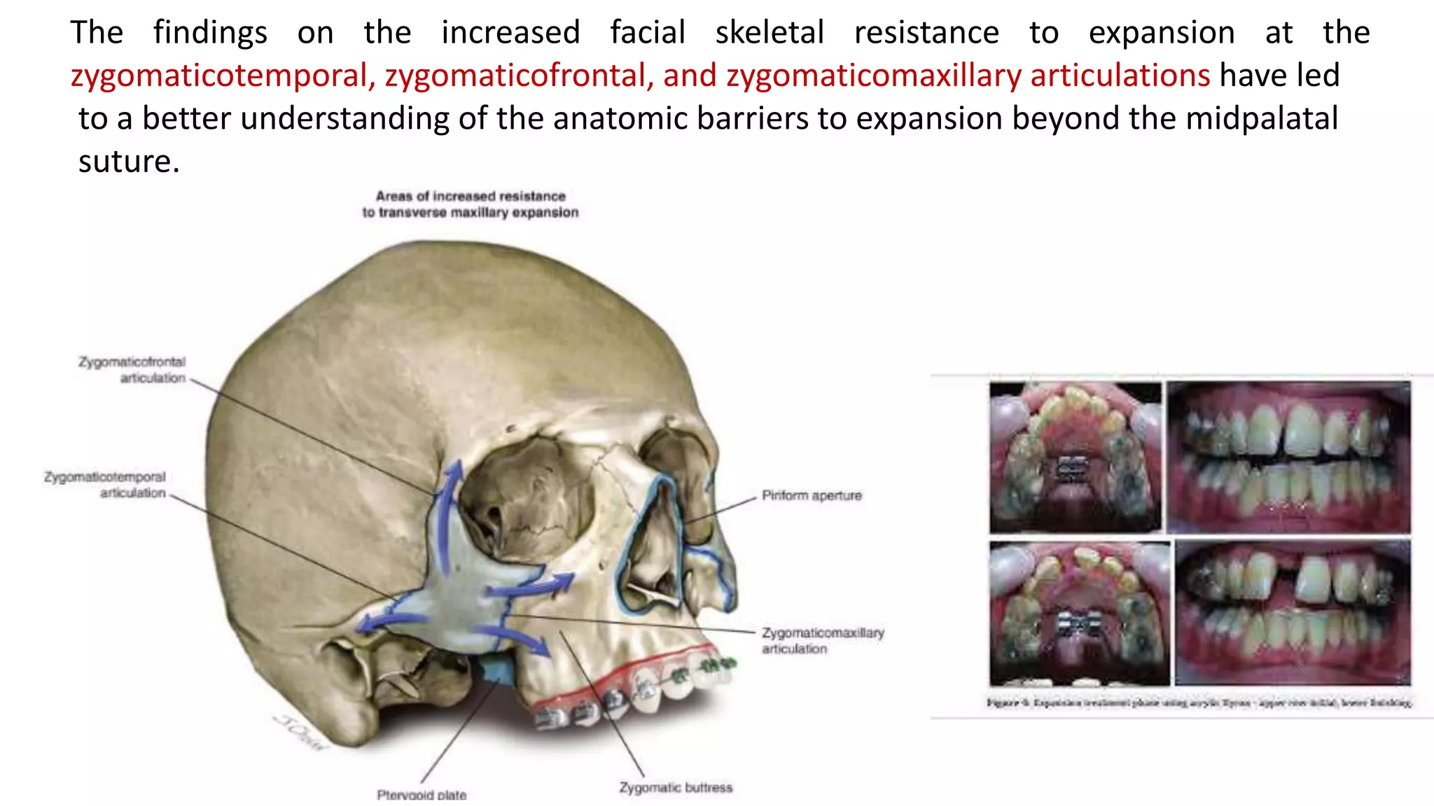 Surgically Assisted Rapid Palatal Expansion (SARPE) | PPTX