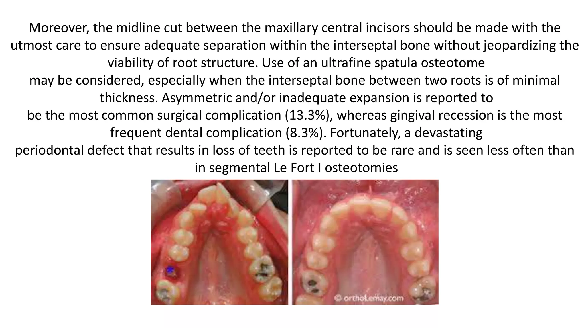Surgically Assisted Rapid Palatal Expansion (SARPE) | PPTX