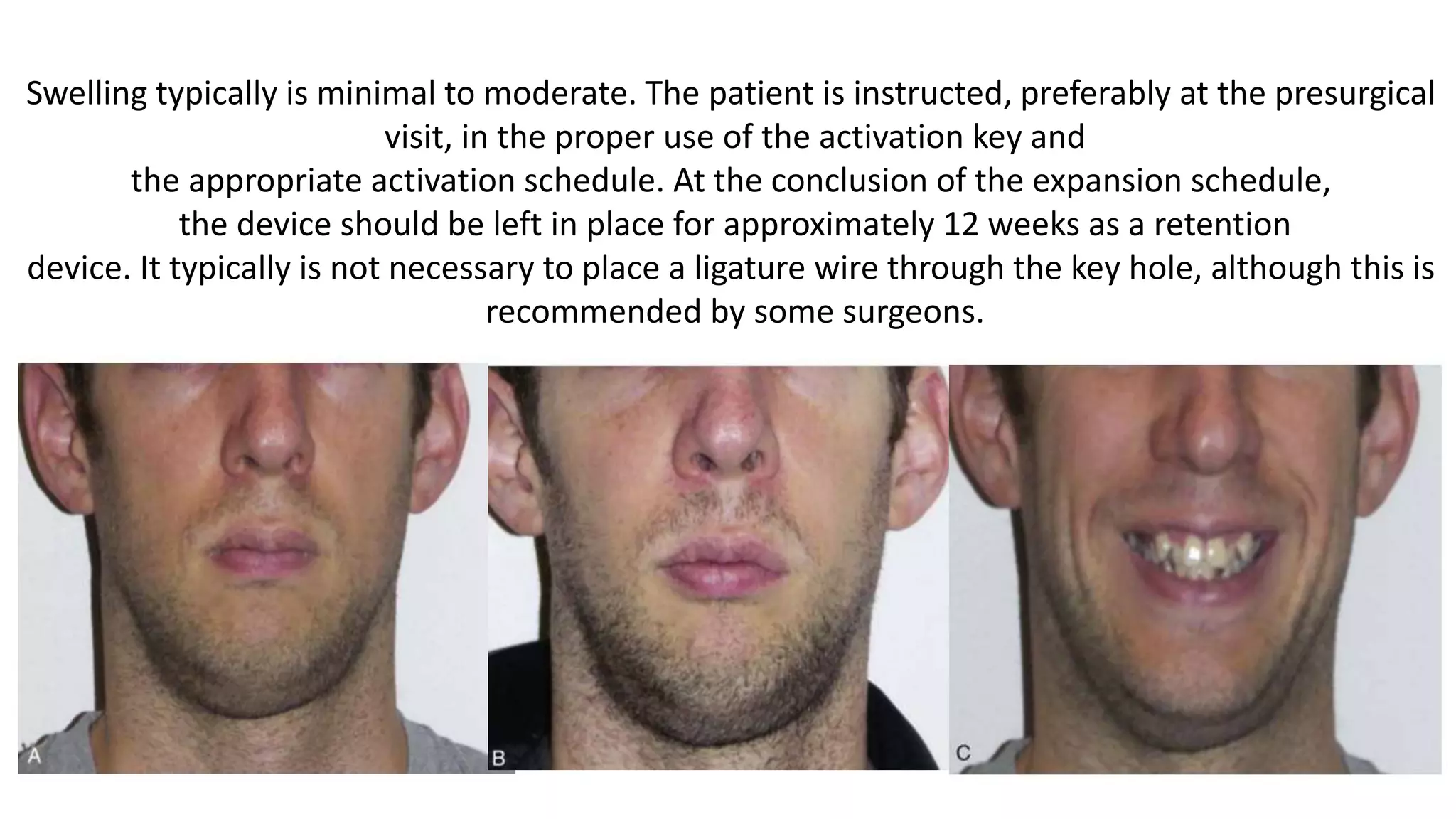 Surgically Assisted Rapid Palatal Expansion (SARPE) | PPTX