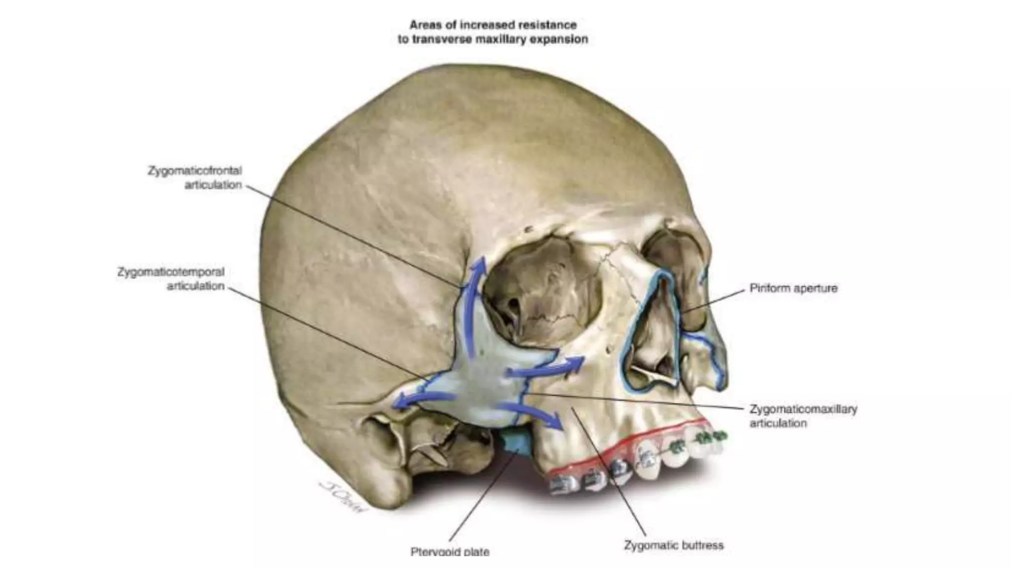Surgically Assisted Rapid Palatal Expansion (SARPE) | PPTX